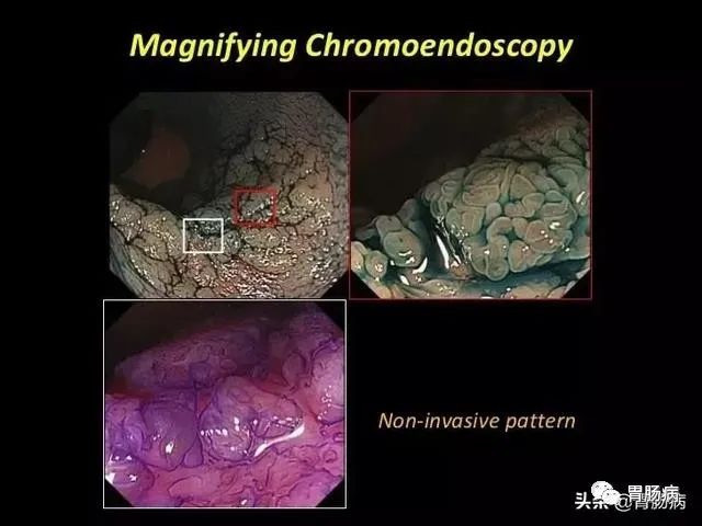 結直腸癌的前身腺瘤性腸息肉