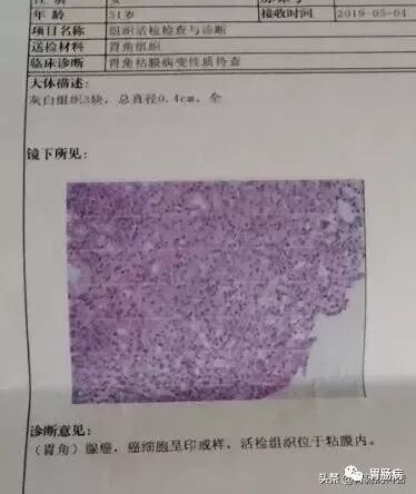 什么是260胃镜快速看懂：胃镜报告+活检病理报告_https://www.jmylbn.com_新闻资讯_第8张