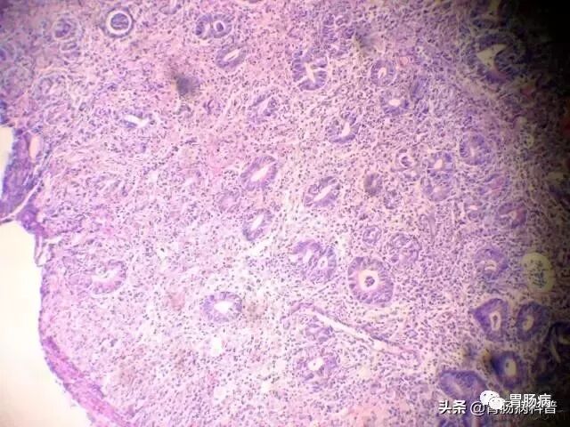 什么是260胃镜快速看懂：胃镜报告+活检病理报告_https://www.jmylbn.com_新闻资讯_第5张