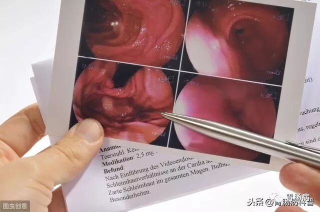 什么是260胃镜快速看懂：胃镜报告+活检病理报告_https://www.jmylbn.com_新闻资讯_第7张