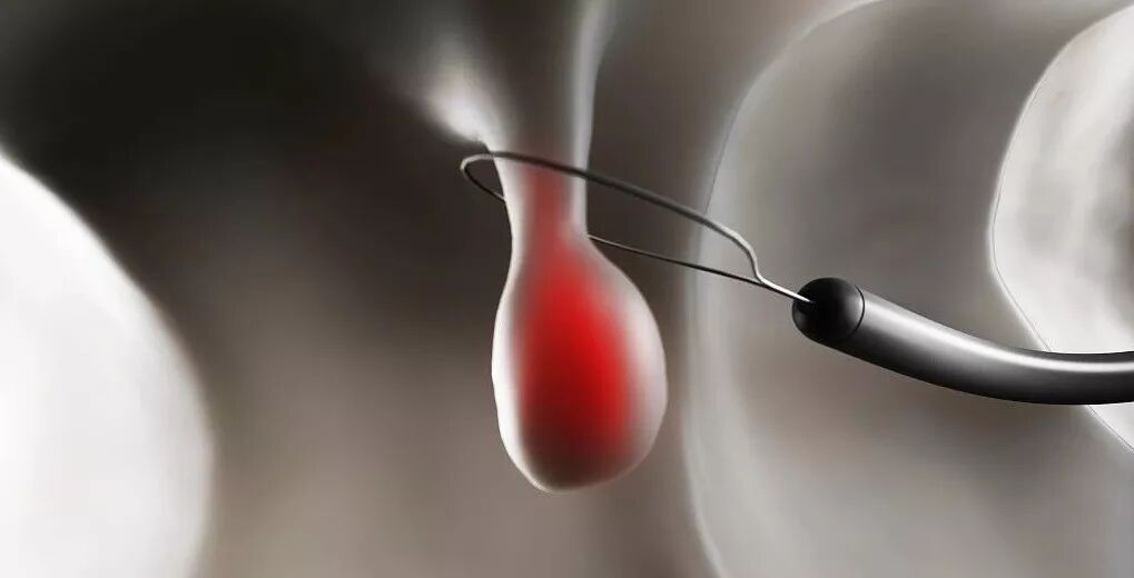 为什么说热活检钳胃肠息肉是怎么长出来的？有什么危害？如何预防和治疗？_https://www.jmylbn.com_新闻资讯_第6张