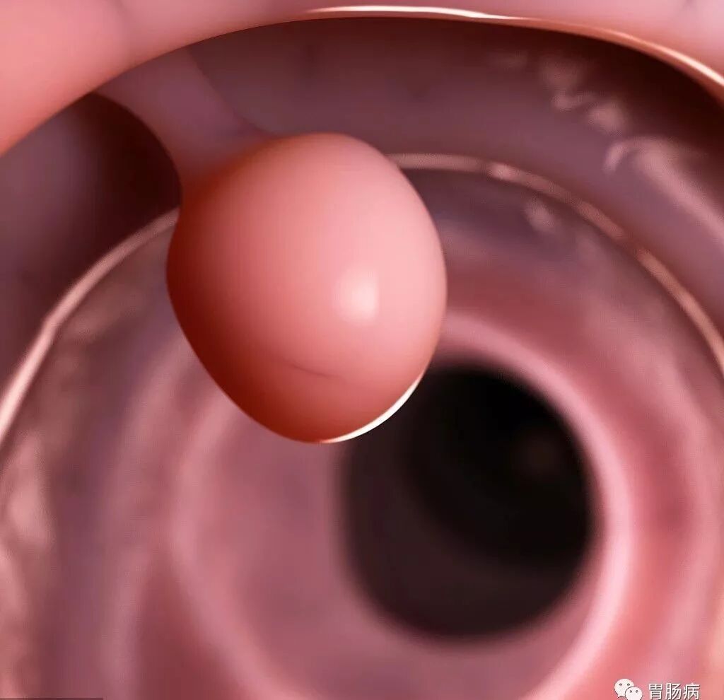 为什么说热活检钳胃肠息肉是怎么长出来的？有什么危害？如何预防和治疗？_https://www.jmylbn.com_新闻资讯_第5张