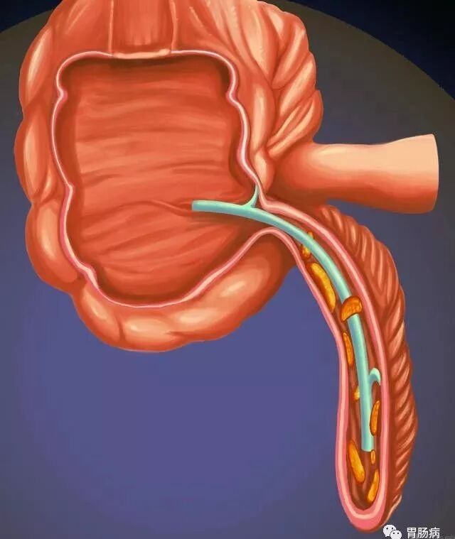 斑马导丝是治疗什么的不开刀，肠镜下治疗阑尾炎——ERAT_https://www.jmylbn.com_新闻资讯_第14张