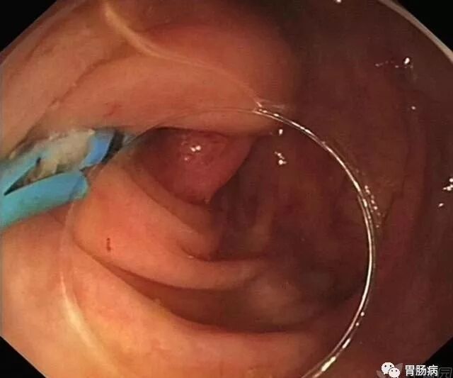 斑马导丝是治疗什么的不开刀，肠镜下治疗阑尾炎——ERAT_https://www.jmylbn.com_新闻资讯_第15张