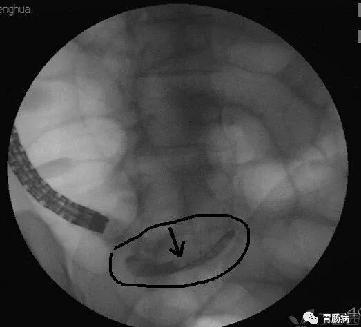 斑马导丝是治疗什么的不开刀，肠镜下治疗阑尾炎——ERAT_https://www.jmylbn.com_新闻资讯_第10张