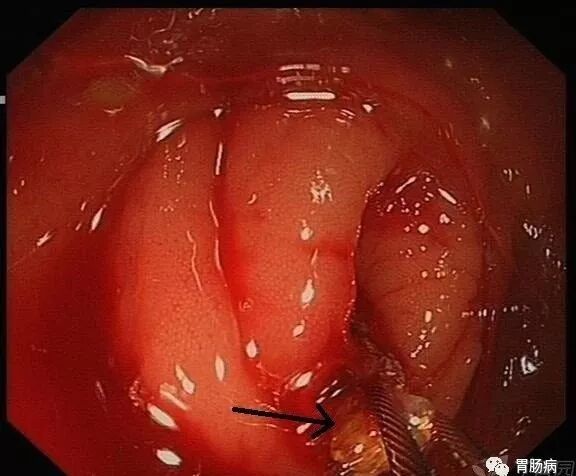 斑马导丝是治疗什么的不开刀，肠镜下治疗阑尾炎 —— ERAT_https://www.jmylbn.com_新闻资讯_第9张