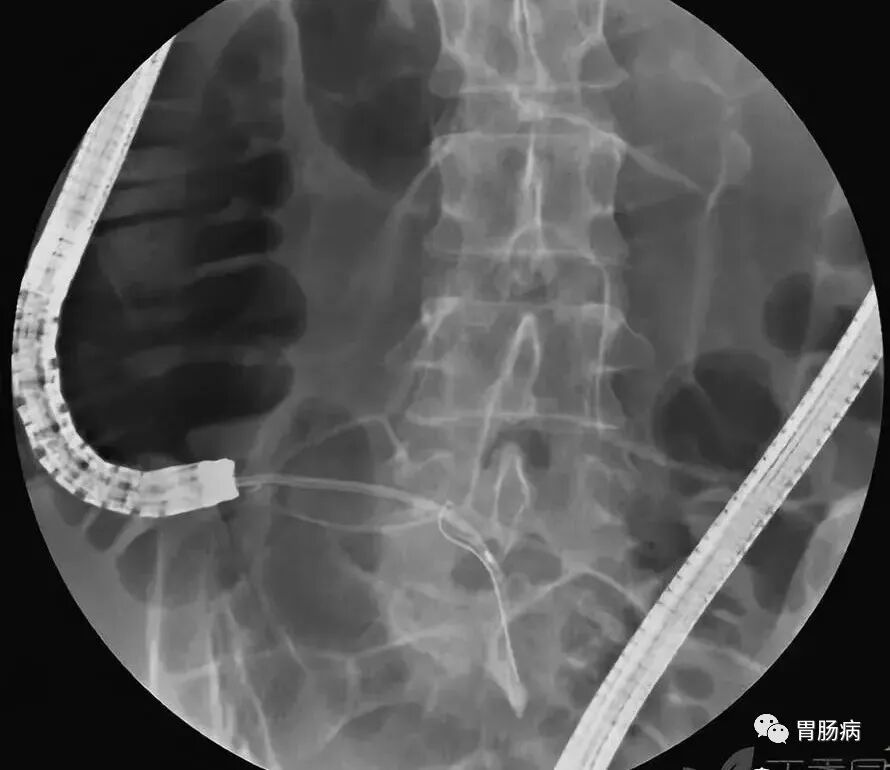 斑马导丝是治疗什么的不开刀，肠镜下治疗阑尾炎 —— ERAT_https://www.jmylbn.com_新闻资讯_第11张