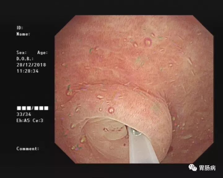 斑马导丝是治疗什么的不开刀，肠镜下治疗阑尾炎 —— ERAT_https://www.jmylbn.com_新闻资讯_第2张