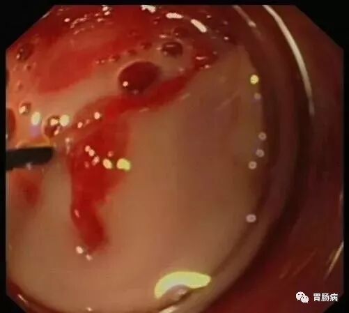 斑马导丝是治疗什么的不开刀，肠镜下治疗阑尾炎 —— ERAT_https://www.jmylbn.com_新闻资讯_第6张