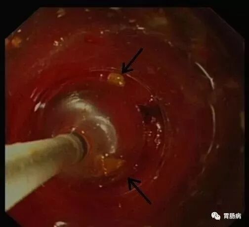 斑马导丝是治疗什么的不开刀，肠镜下治疗阑尾炎 —— ERAT_https://www.jmylbn.com_新闻资讯_第8张