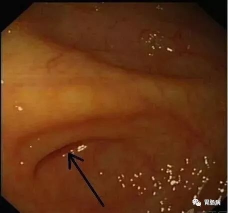 斑马导丝是治疗什么的不开刀，肠镜下治疗阑尾炎 —— ERAT_https://www.jmylbn.com_新闻资讯_第12张