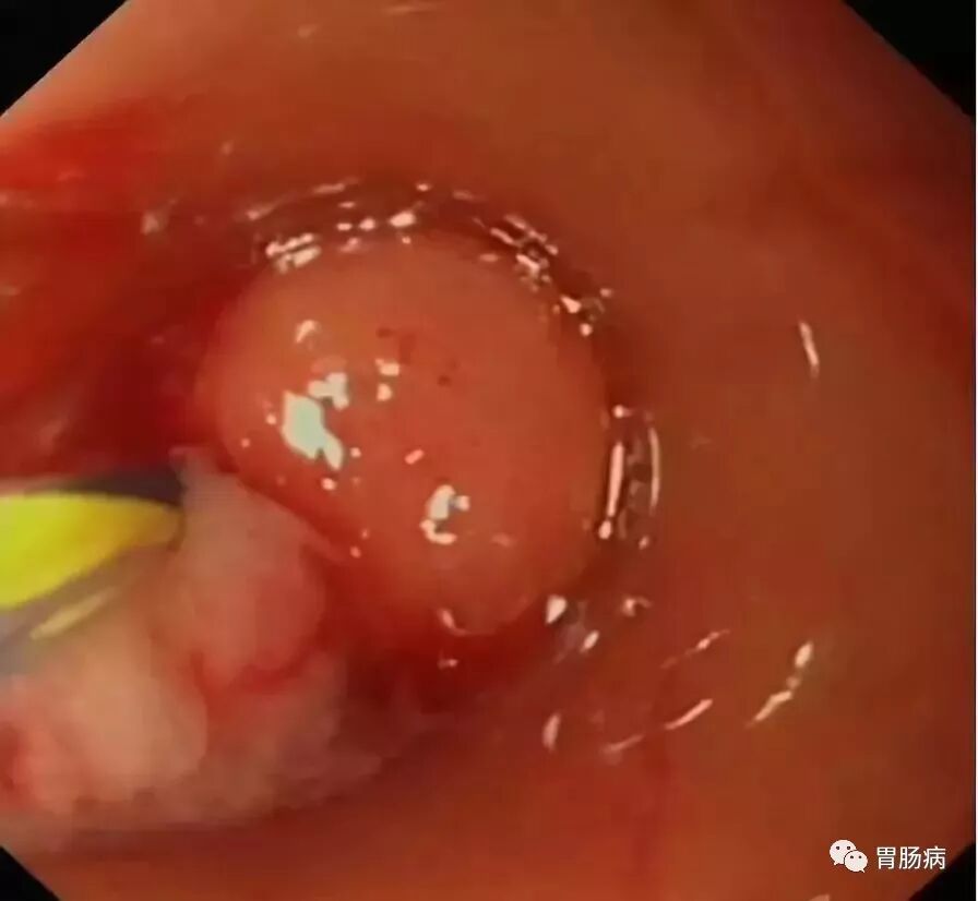 斑马导丝是治疗什么的不开刀，肠镜下治疗阑尾炎——ERAT_https://www.jmylbn.com_新闻资讯_第8张