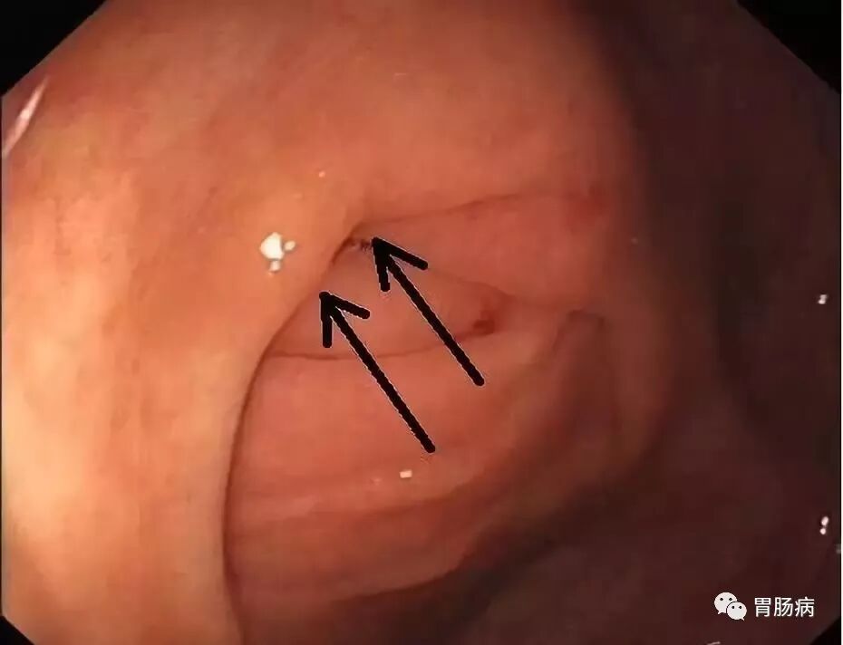 斑马导丝是治疗什么的不开刀，肠镜下治疗阑尾炎 —— ERAT_https://www.jmylbn.com_新闻资讯_第4张