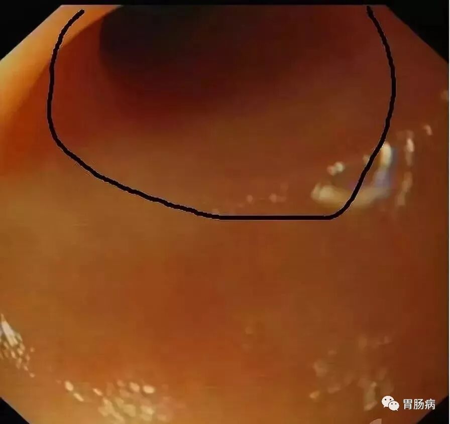 斑马导丝是治疗什么的不开刀，肠镜下治疗阑尾炎 —— ERAT_https://www.jmylbn.com_新闻资讯_第13张
