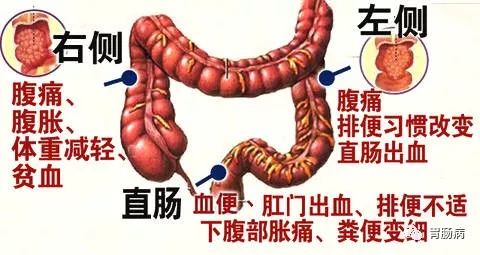 小心！這樣的大便，可能是大腸癌來臨！ 健康 第7張