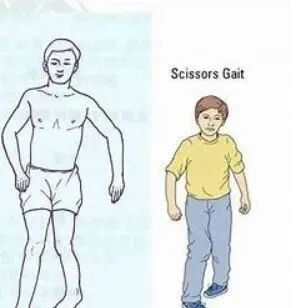 步态分析上曲线怎么解读步态分析的常用方法，很实用！_https://www.jmylbn.com_新闻资讯_第11张