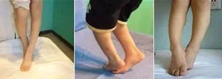 步态分析上曲线怎么解读步态分析的常用方法，很实用！_https://www.jmylbn.com_新闻资讯_第12张