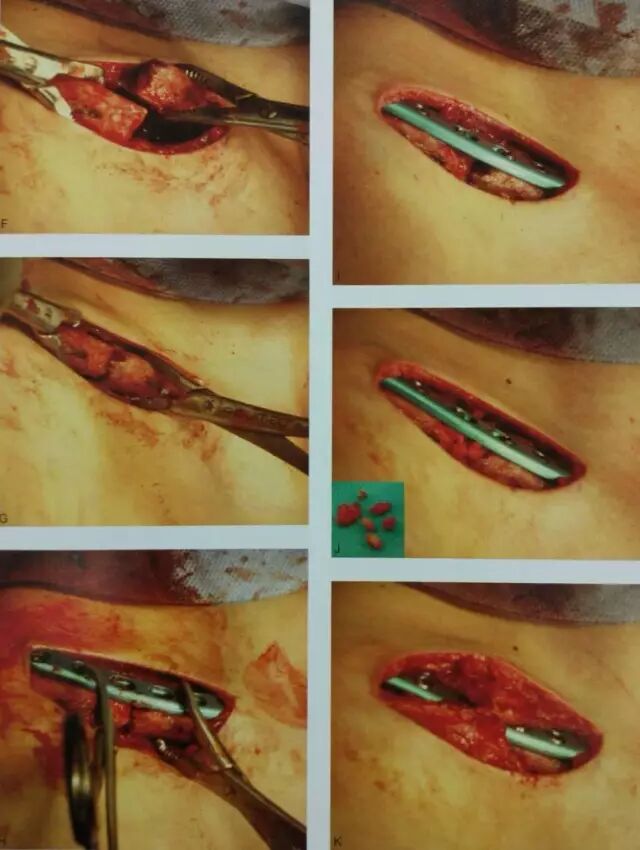 锁骨骨折手术技术:加压钢板内固定_医学界-助力医生临床决策和职业