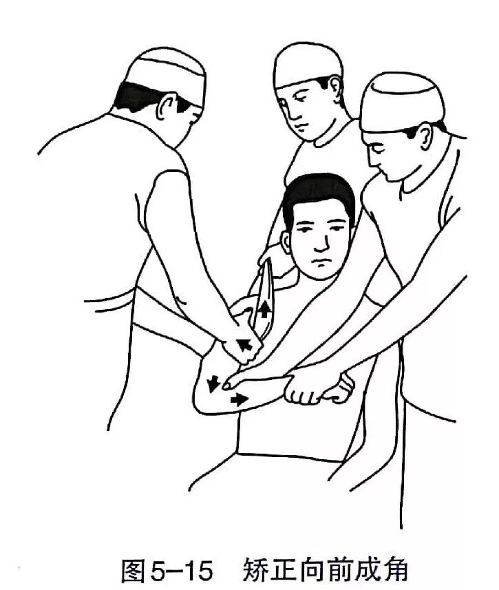 Illustration 4 for BC D型孟氏骨折及全身各部位骨折的专家级手法复位术：掌握技巧，告别痛苦，骨折康复更简单、更快速！