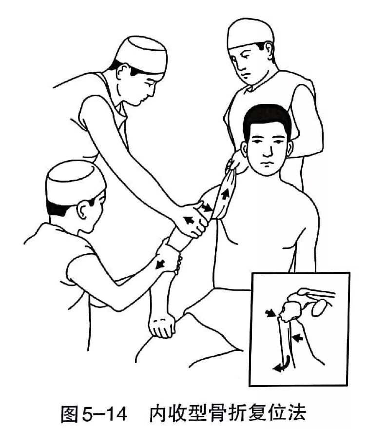 Illustration 3 for BC D型孟氏骨折及全身各部位骨折的专家级手法复位术：掌握技巧，告别痛苦，骨折康复更简单、更快速！