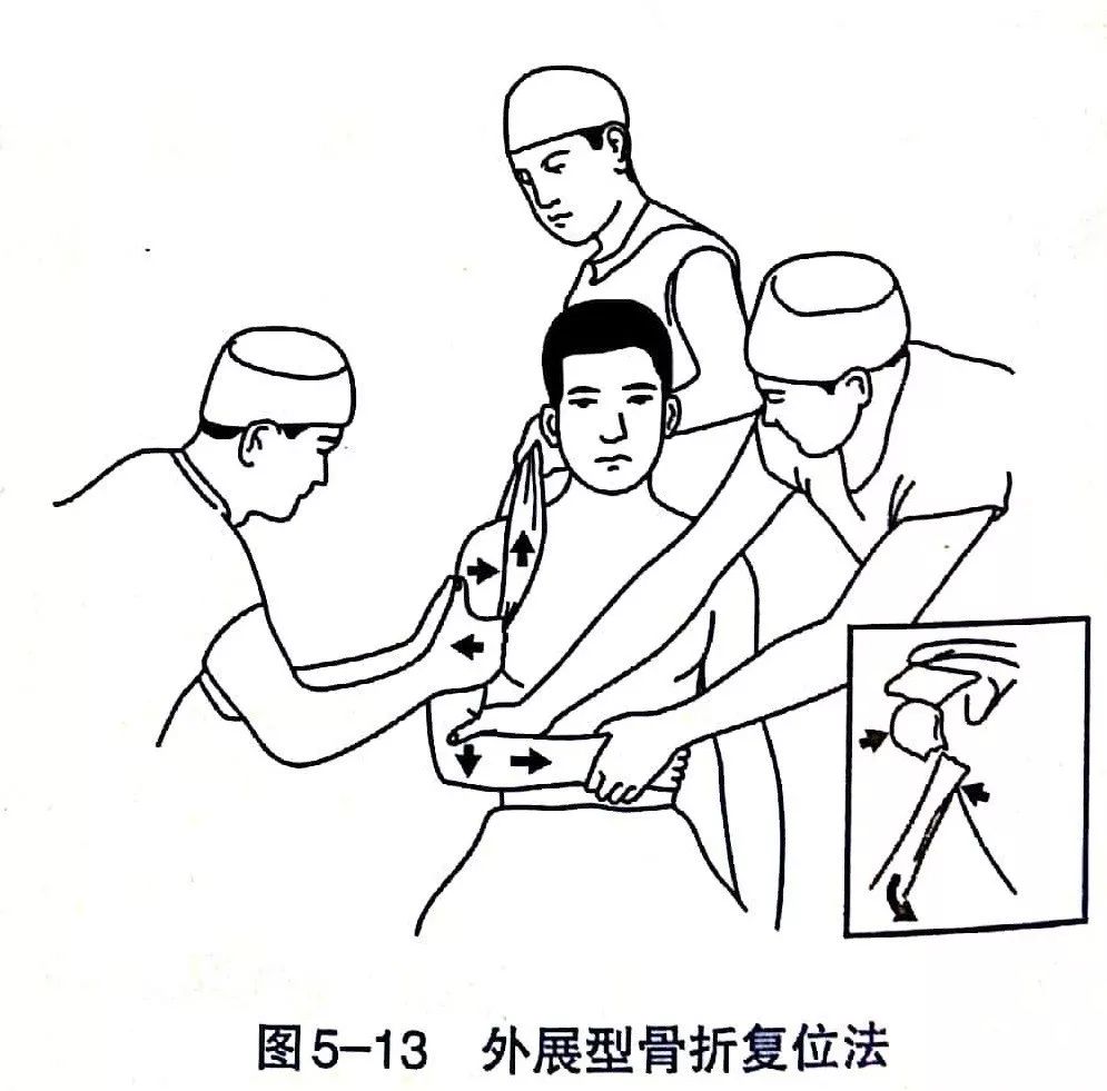 Illustration 2 for BC D型孟氏骨折及全身各部位骨折的专家级手法复位术：掌握技巧，告别痛苦，骨折康复更简单、更快速！