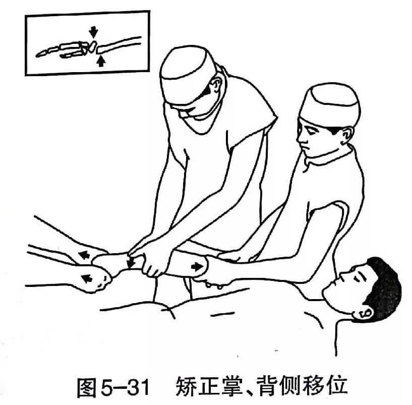 Illustration 27 for BC D型孟氏骨折及全身各部位骨折的专家级手法复位术：掌握技巧，告别痛苦，骨折康复更简单、更快速！