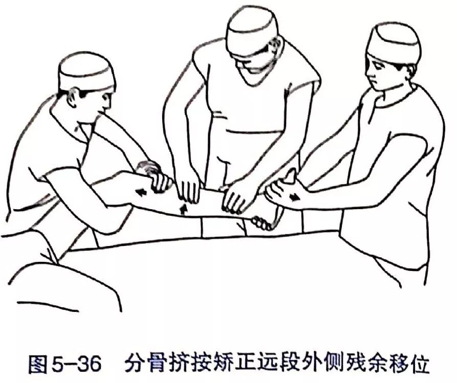 Illustration 33 for BC D型孟氏骨折及全身各部位骨折的专家级手法复位术：掌握技巧，告别痛苦，骨折康复更简单、更快速！