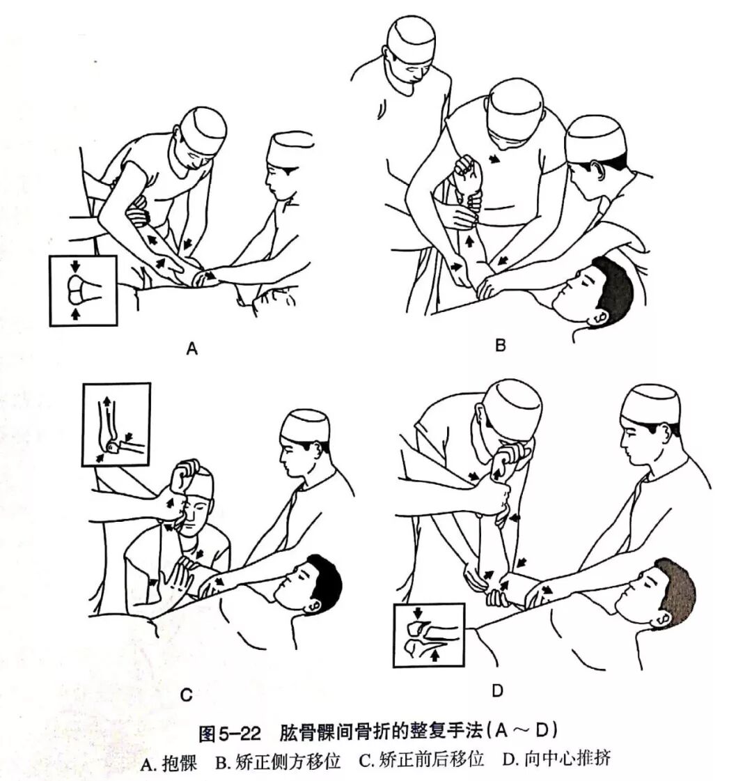 Illustration 14 for BC D型孟氏骨折及全身各部位骨折的专家级手法复位术：掌握技巧，告别痛苦，骨折康复更简单、更快速！