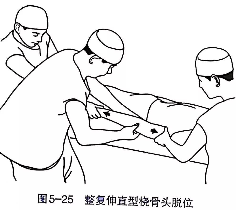 Illustration 19 for BC D型孟氏骨折及全身各部位骨折的专家级手法复位术：掌握技巧，告别痛苦，骨折康复更简单、更快速！