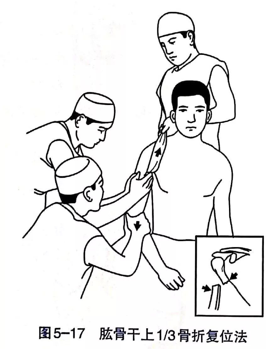 Illustration 7 for BC D型孟氏骨折及全身各部位骨折的专家级手法复位术：掌握技巧，告别痛苦，骨折康复更简单、更快速！