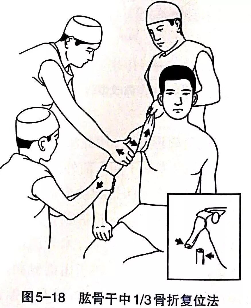 Illustration 8 for BC D型孟氏骨折及全身各部位骨折的专家级手法复位术：掌握技巧，告别痛苦，骨折康复更简单、更快速！