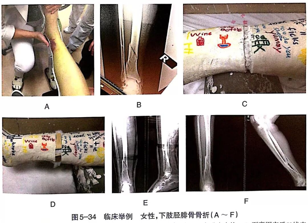 Illustration 31 for BC D型孟氏骨折及全身各部位骨折的专家级手法复位术：掌握技巧，告别痛苦，骨折康复更简单、更快速！