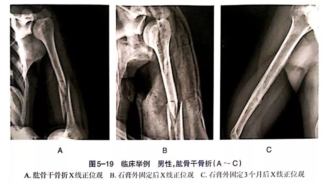 Illustration 9 for BC D型孟氏骨折及全身各部位骨折的专家级手法复位术：掌握技巧，告别痛苦，骨折康复更简单、更快速！