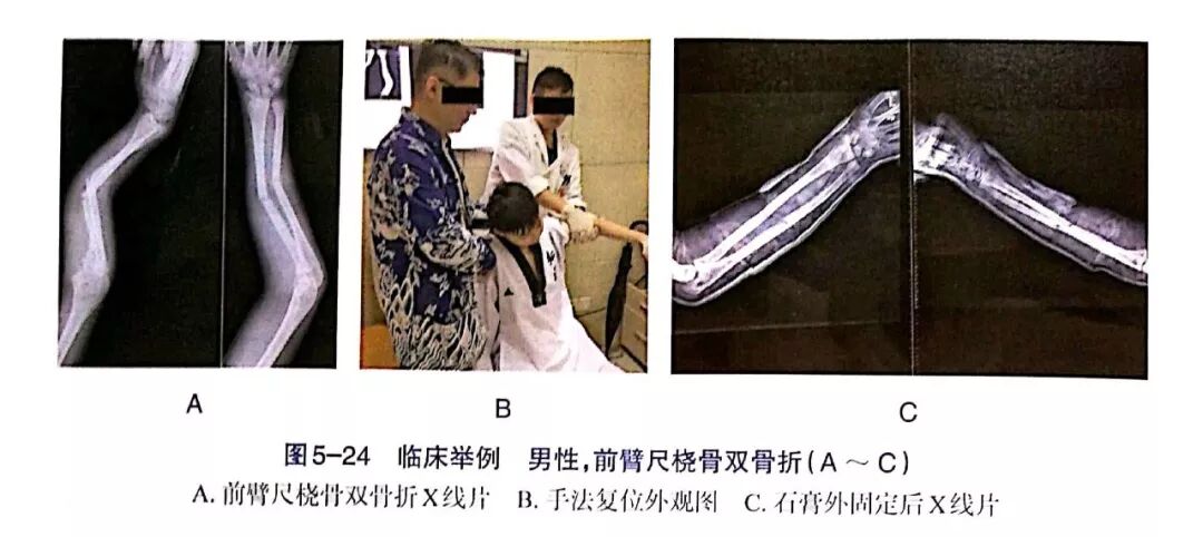 Illustration 17 for BC D型孟氏骨折及全身各部位骨折的专家级手法复位术：掌握技巧，告别痛苦，骨折康复更简单、更快速！