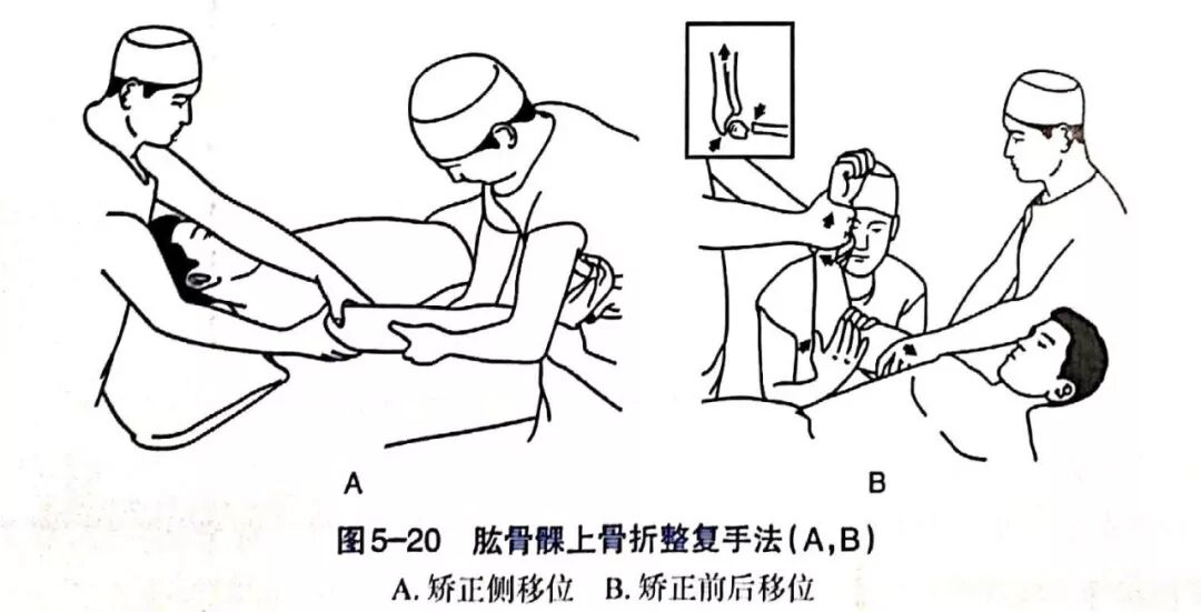 Illustration 11 for BC D型孟氏骨折及全身各部位骨折的专家级手法复位术：掌握技巧，告别痛苦，骨折康复更简单、更快速！