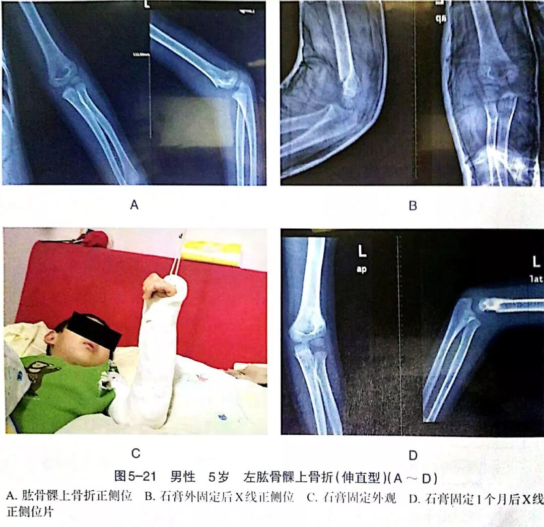Illustration 12 for BC D型孟氏骨折及全身各部位骨折的专家级手法复位术：掌握技巧，告别痛苦，骨折康复更简单、更快速！