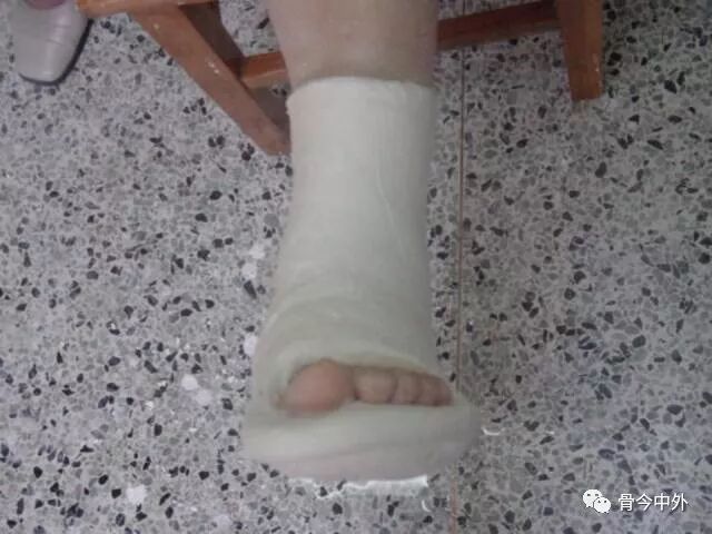 骨折石膏固定大百科-陆超杰住院医师-爱问医生