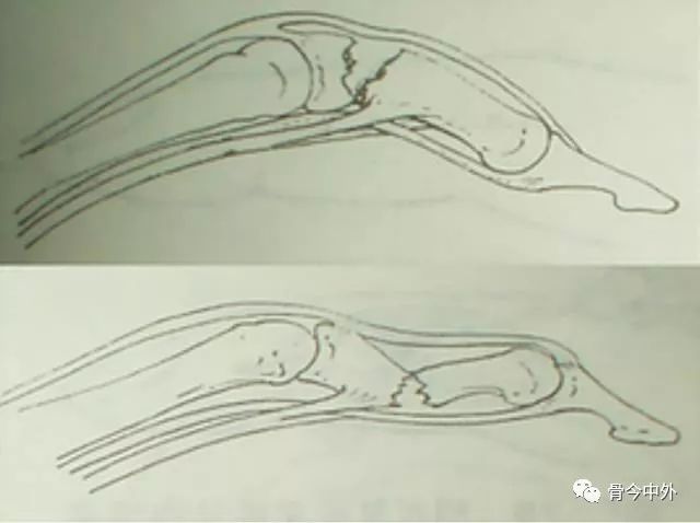 末節指骨骨折:腕,掌指,指間關節功能位6周;1,長腿石膏管型(託):大腿