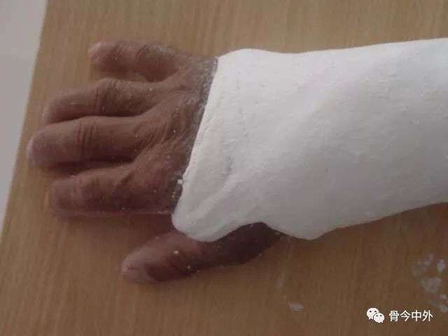 骨折石膏固定大百科-陆超杰住院医师-爱问医生