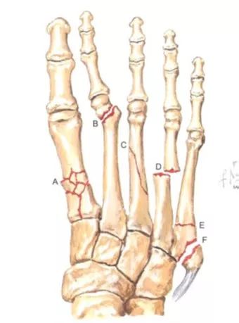 足部骨折的分類及治療 看這篇就夠了 骨今中外 微文庫