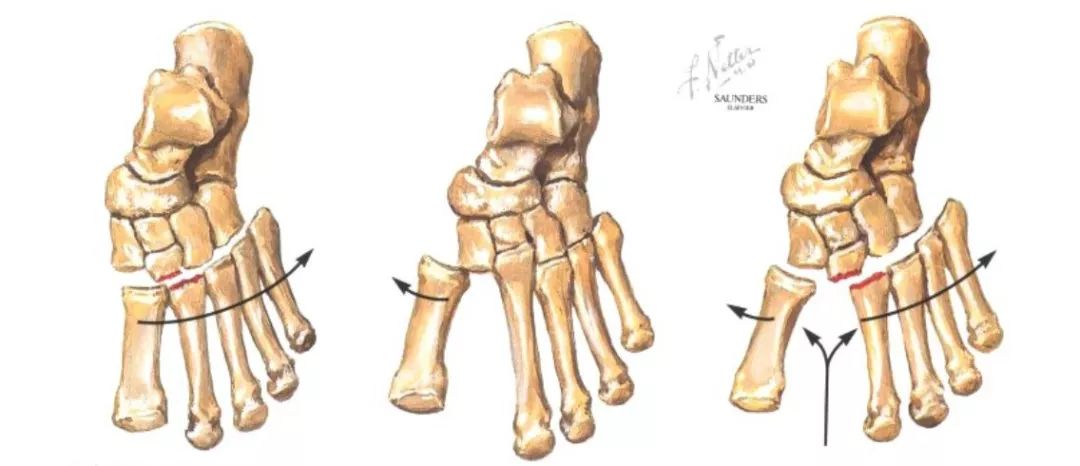 足部骨折的分類及治療 看這篇就夠了 骨今中外 微文庫