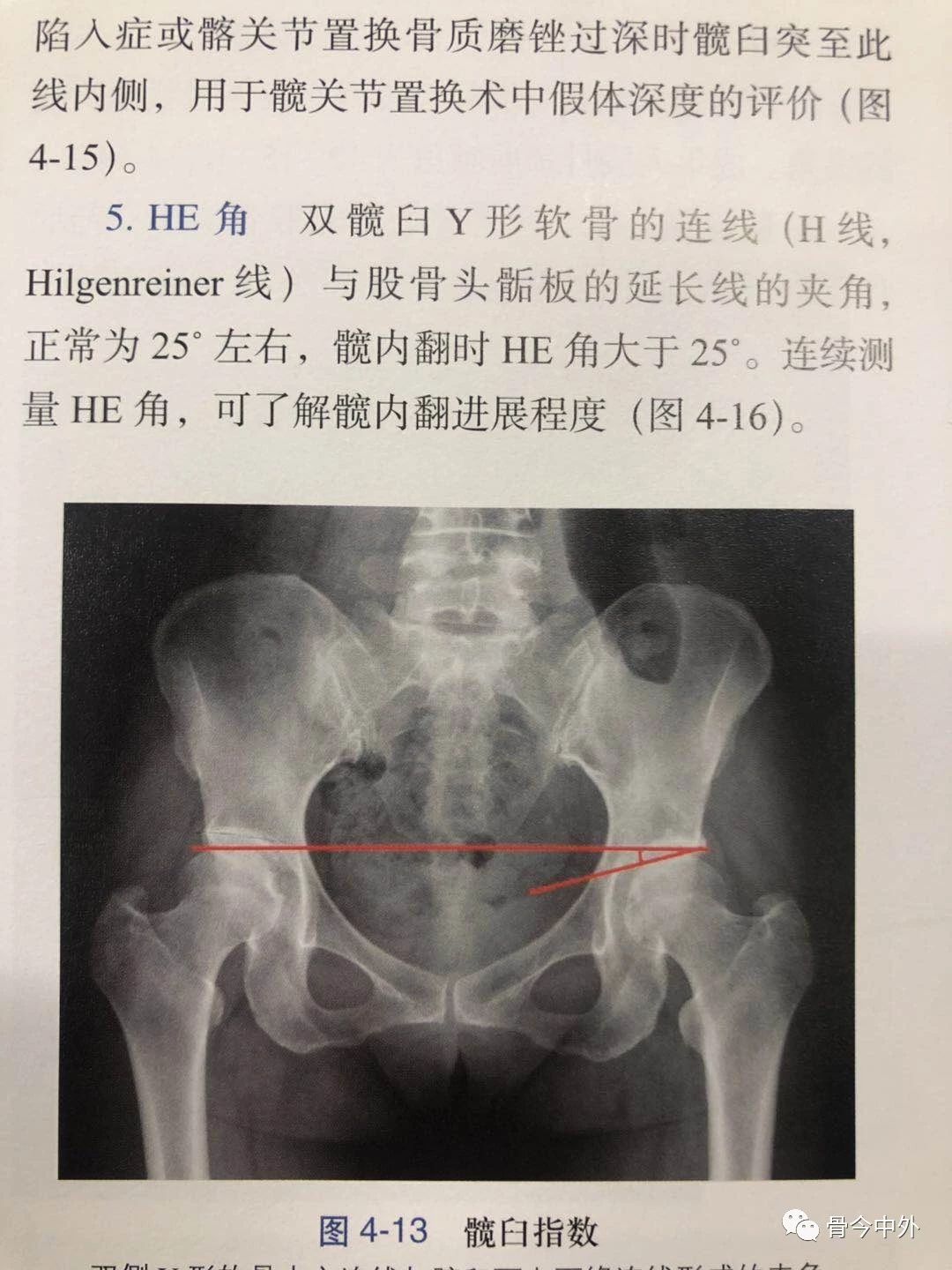 诚德骨科医院成功开展髋臼周围截骨术治疗髋关节发育不良-学术动态-诚德骨科医院-枣庄市诚德骨科医院有限公司