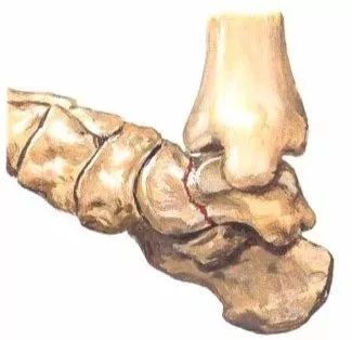足部骨折的分类及治疗 看这篇就够了 骨今中外 微信公众号文章阅读 Wemp