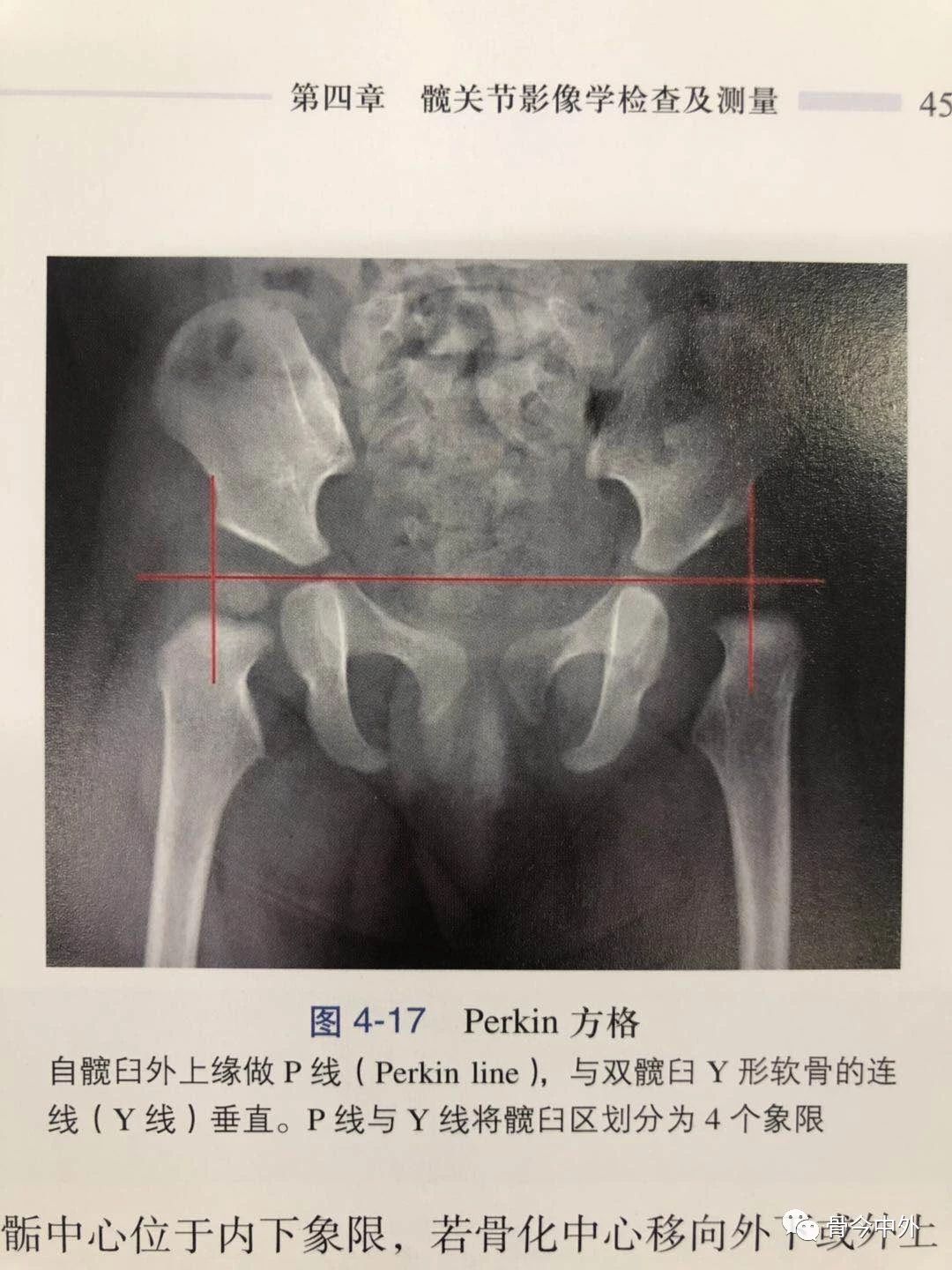 髋关节联合前倾角图解,联合前倾角的示意图,髋臼前倾角图示(第8页)_大山谷图库