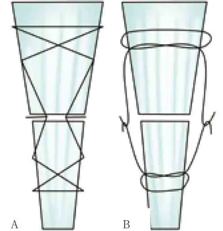缝合器都有哪些厂家跟腱断裂常用的四种缝合修复方法，你都知道吗？_https://www.jmylbn.com_新闻资讯_第5张