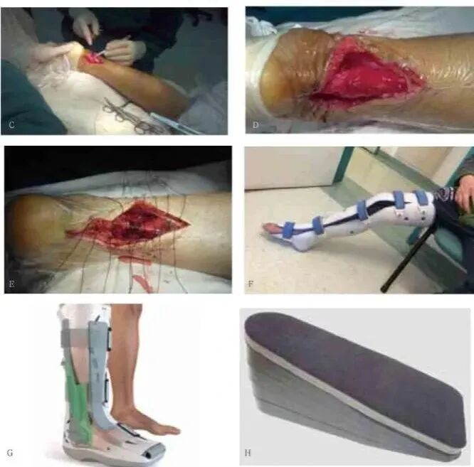 缝合器都有哪些厂家跟腱断裂常用的四种缝合修复方法，你都知道吗？_https://www.jmylbn.com_新闻资讯_第3张