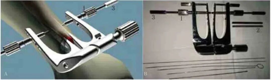 缝合器都有哪些厂家跟腱断裂常用的四种缝合修复方法，你都知道吗？_https://www.jmylbn.com_新闻资讯_第4张