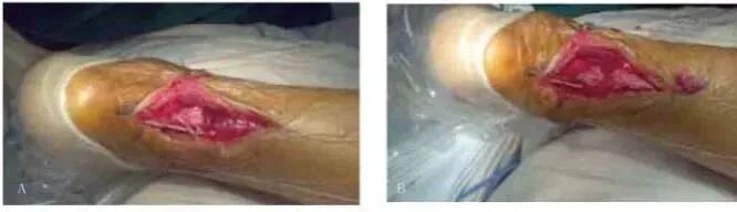 缝合器都有哪些厂家跟腱断裂常用的四种缝合修复方法，你都知道吗？_https://www.jmylbn.com_新闻资讯_第1张