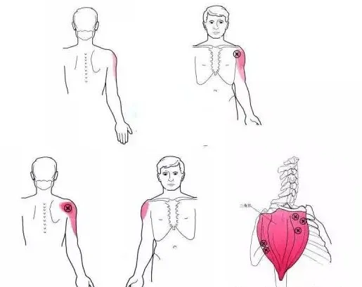 怎么评估病人肌力“肩 髋 膝 踝” 4大关节体格检查,干货速取!_新闻资讯_第7张_活检穿刺产品网 怎么评估病人肌力“肩 髋 膝 踝” 4大关节体格检查,干货速取!_https://www.jmylbn.com_新闻资讯_第7张