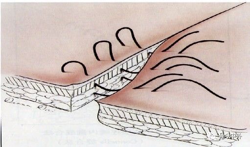 缝合针怎么选规格外科手术“3大缝合工具+7种缝合方式”，超级实用！_https://www.jmylbn.com_新闻资讯_第9张